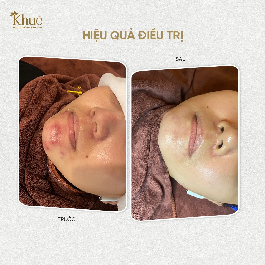 Hiệu quả điều trị mụn
