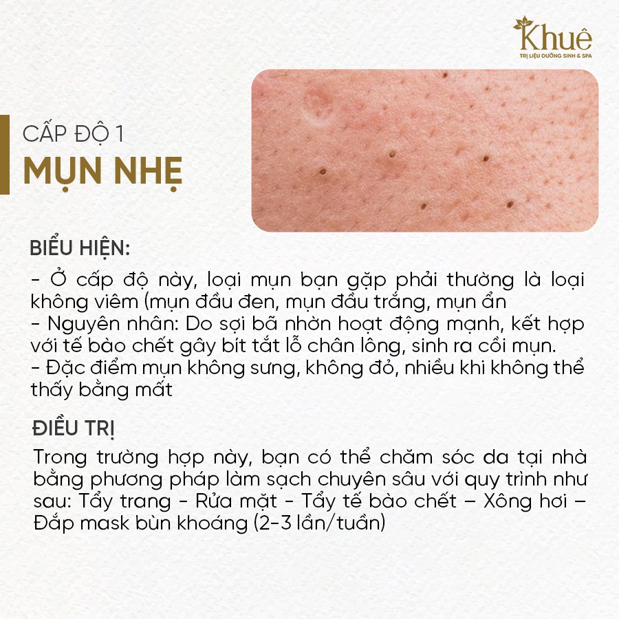 Mụn cấp độ 1 - Mụn nhẹ