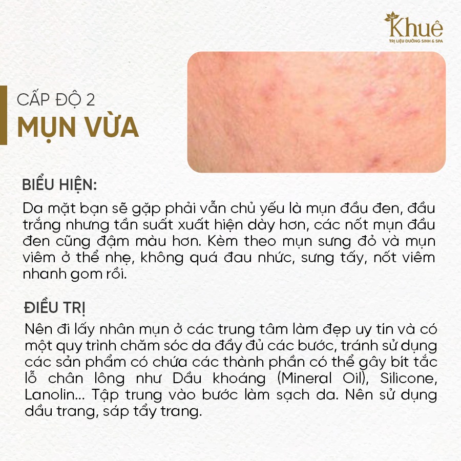 Mụn cấp độ 2 - Mụn vừa