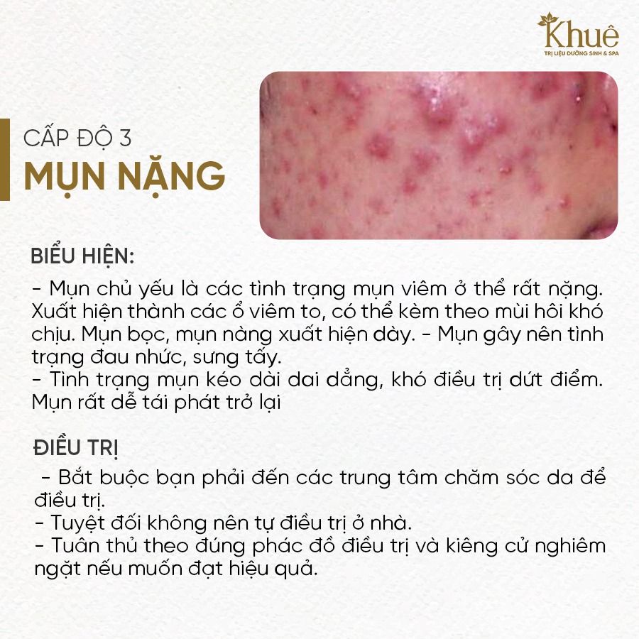 Mụn cấp độ 3 - Mụn nặng